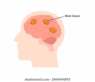 Brain cancer or tumor in head Human brain Anatomy vector illustration.	
