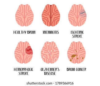 Brain diseases. Meningitis, ischemic and hemorrhagic stroke, alzheimer's disease, cancer. Neurobiology. Vector flat illustration. Perfect for flyer, medical brochure, banner, landing page, website