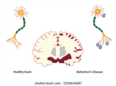 Brain divided in two showing at the left a healthy brain and neuron and in the right side a brain and a neuron affected by alzheimer's disease. 