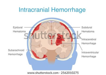 Brain hemorrhage 4 types including Epidural hemorrhage, Subdural , Subarachnoid, and Intraparenchymal. Anatomy of brain hemorrhage.