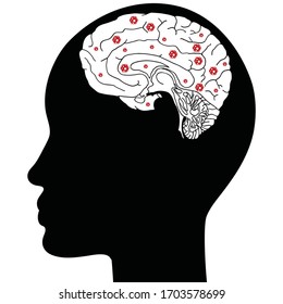 cerebro infectado por coronavirus - ilustración vectorial 