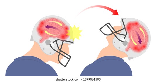 Brain Injury mild post head bleed sport loss second bump blow jolt hit skull ear contact hockey trauma fall pain athlete ball rugby play