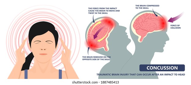 Brain Injury Mild Post Head Bleed Sport Loss Second Bump Blow Jolt Hit Skull Ear Contact Hockey Trauma Fall Pain Athlete Ball Rugby Play