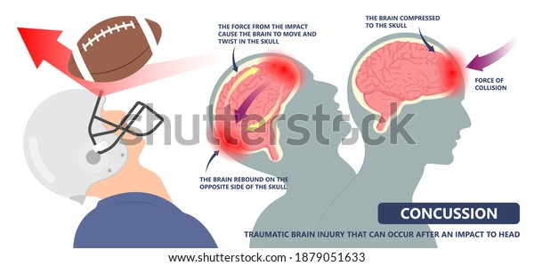 Brain Injury mild post head bleed sport loss second\
bump blow jolt hit skull ear contact hockey trauma fall pain\
athlete ball rugby play