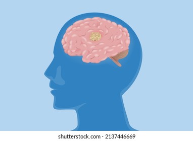 The brain in the silhouette human head has a tumor. medical diagram about Cancer cell metastasis at the human internal organ and nervous system.