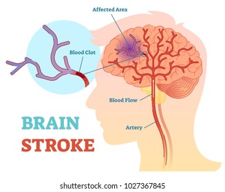 Brain Stroke anatomical vector illustration diagram, scheme with brains blood flow and blood clot.
