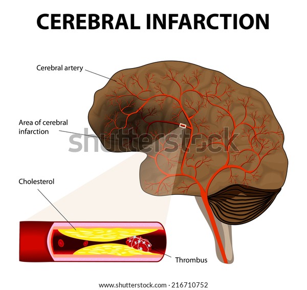 Brain Stroke Cerebral Infarction Obstruction Caused Stock Vector ...