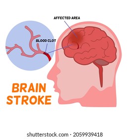 Concepto de infarto cerebral, cerebro humano con imagen de punto rojo y coágulo sanguíneo junto a la cabeza humana