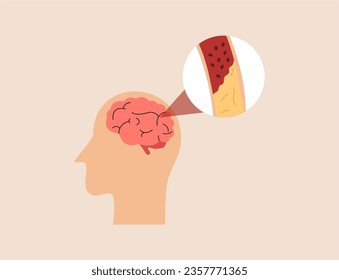 Brain stroke disease, atherosclerosis, hemorrhage and pain point. Vector flat infographic medical concept illustration. Design for poster, print, background, landing page.