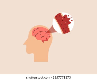 Brain stroke disease, atherosclerosis, hemorrhage and pain point. Vector flat infographic medical concept illustration. Design for poster, print, background, landing page.