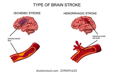 Brain stroke, hemorrhagic and ischemic. Arteriosclerosis, infarct, ischemia, thrombosis disease. Cholesterol in human blood vessels. Medical poster vector illustration.