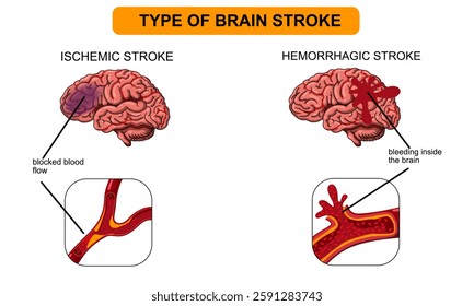 Brain stroke, hemorrhagic and ischemic. Arteriosclerosis, infarct, ischemia, thrombosis disease. Cholesterol in human blood vessels. Medical poster vector illustration.