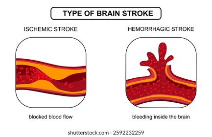 Brain stroke, hemorrhagic and ischemic. Arteriosclerosis, infarct, ischemia, thrombosis disease. Cholesterol in human blood vessels. Medical poster vector illustration.