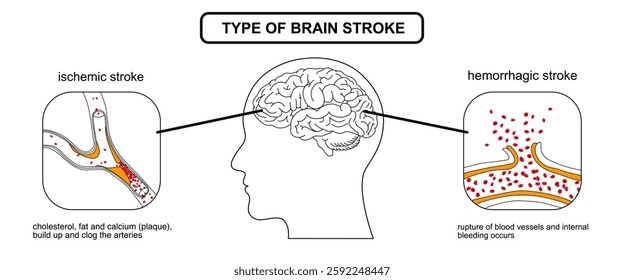 Brain stroke, hemorrhagic and ischemic. Arteriosclerosis, infarct, ischemia, thrombosis disease. Cholesterol in human blood vessels. Medical poster vector illustration.