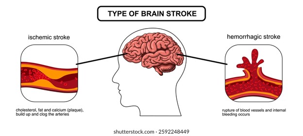 Brain stroke, hemorrhagic and ischemic. Arteriosclerosis, infarct, ischemia, thrombosis disease. Cholesterol in human blood vessels. Medical poster vector illustration.