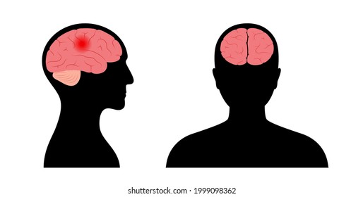 Brain stroke, hemorrhagic and ischemic problem. Pain in human head. Arteriosclerosis, infarct, ischemia, thrombosis disease. Cholesterol in human blood vessels. Medical poster vector illustration.