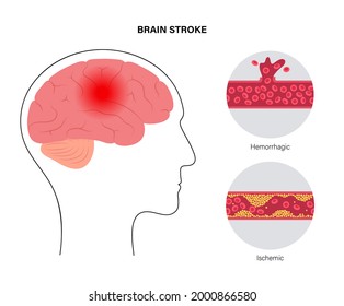 Brain stroke, hemorrhagic and ischemic problem. Arteriosclerosis, infarct, ischemia, thrombosis disease. High ldl and hdl level. Cholesterol in human blood vessels. Medical poster vector illustration.