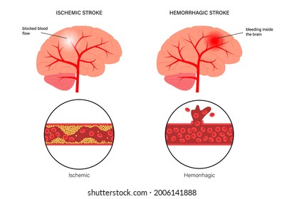 Brain stroke, hemorrhagic and ischemic problem. Arteriosclerosis, infarct, ischemia, thrombosis disease. High ldl and hdl level. Cholesterol in human blood vessels. Medical poster vector illustration.