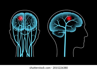 Brain stroke, hemorrhagic and ischemic problem. Pain in human head. Arteriosclerosis, infarct, ischemia, thrombosis disease. Cholesterol in human blood vessels. Medical poster vector illustration.