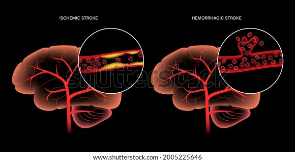 Brain Stroke Hemorrhagic Ischemic Problem Arteriosclerosis Stock Vector ...