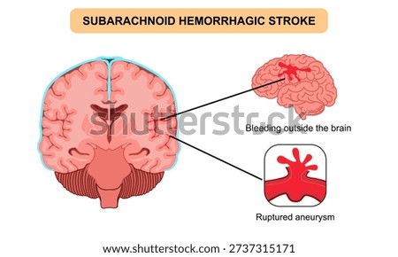 Brain stroke hemorrhagic subarachnoid. Ruptured aneurysm, bleeding outside teh brain. Arteriosclerosis, infarct, ischemia, thrombosis disease. Medical poster vector illustration and education.