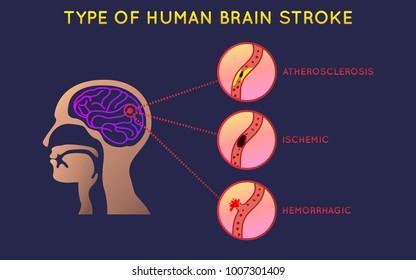Brain Stroke icon design, infographic health, medical infographic. Vector illustration