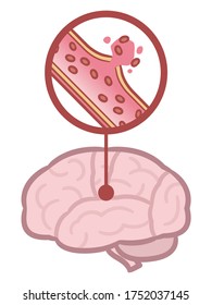 Brain Stroke - Illustration Of Cerebral Hemorrhage