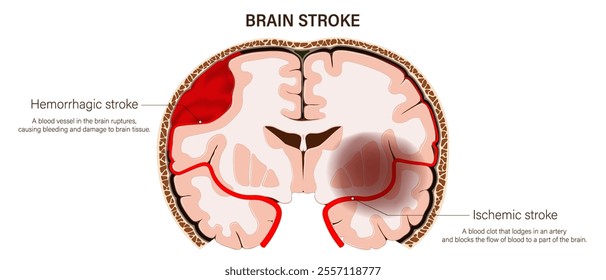 Brain stroke vector. Hemorrhagic stroke and Ischemic stroke. Brain tissue death. Human brain anatomy structure.