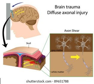 Brain trauma with axon shear (car accident, shaken baby syndrome,..)