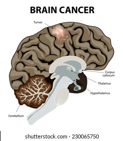 A brain tumor is an abnormal growth of tissue in the brain. Human anatomy