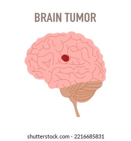 Brain tumor disease in flat design vector illustration.