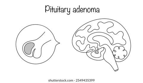 Um tumor cerebral localizado na cavidade da sela turca, perto da base dos ossos do crânio. Adenoma hipofisário desenhado à mão. Ilustração de vetor médico. Vetor preto e branco.