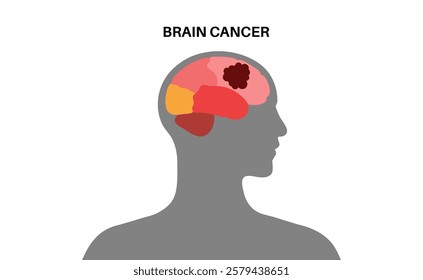 Brain tumor medical poster. Cancer, metastasis or benign in the human head or in the nerves, pituitary gland, pineal gland, and membranes that cover the surface of the brain flat vector illustration