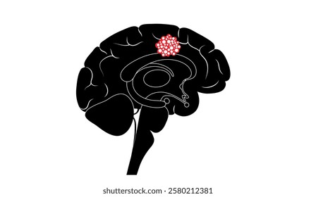 Brain tumor medical poster. Cancer, metastasis or benign in the human head or in the nerves, pituitary gland, pineal gland, and membranes that cover the surface of the brain flat vector illustration
