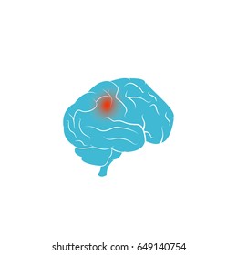 Ilustración del vector del tumor cerebral aislada en fondo blanco