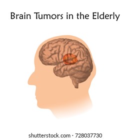 Brain tumors, cancer in the elderly. Vector medical illustration. Old people. White background, silhouette of old man head, anatomy image.