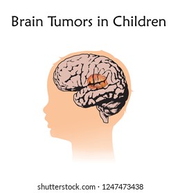 Brain Tumors, Cancer In Infants, Childhood. Vector Medical Illustration. Kid, Baby, Childhood. White Background, Silhouette Of Child Head, Anatomy Flat Image.