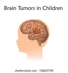 Brain Tumors, Cancer In Infants, Childhood. Vector Medical Illustration. Kid, Baby, Childhood. White Background, Silhouette Of Child Head, Anatomy Image.