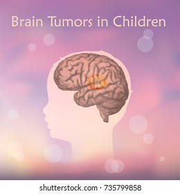 Brain Tumors, Cancer In Infants, Childhood. Vector Medical Illustration. Kid, Baby, Childhood. Blurred Pink Background, Silhouette Of Child Head, Anatomy Image.