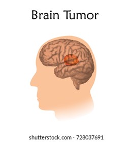 Brain tumors, cancer. Vector medical illustration. White background, silhouette of man head, anatomy image.