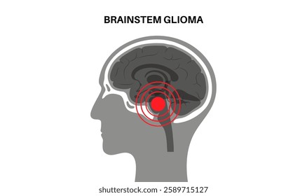 Brainstem glioma medical poster. Cancerous glioma tumor in the brainstem. Children or young adults cancer. Brain or spinal cord tissue inflammation. Central nervous system disorder vector illustration