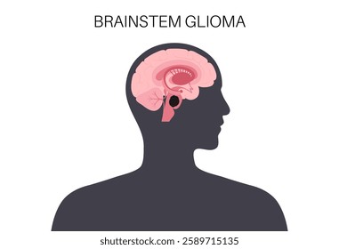 Brainstem glioma medical poster. Cancerous glioma tumor in the brainstem. Children or young adults cancer. Brain or spinal cord tissue inflammation. Central nervous system disorder vector illustration