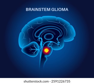 Brainstem glioma medical poster. Cancerous glioma tumor in the brainstem. Children or young adults cancer. Brain or spinal cord tissue inflammation. Central nervous system disorder vector illustration