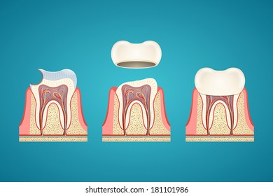 Breaking teeth on blue background