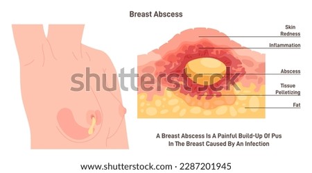 Breast abscess. Cross-section of the female chest with inflammation and pus formation. Human anatomy banner. Flat vector illustration