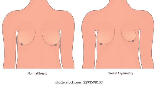 breast asymmetry and normal breast 