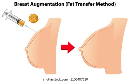 Breast Augmentation Fat Transfer Method Illustration