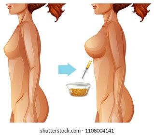 Breast Augmentation Fat Transfer Method Illustration