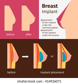 Breast augmentation infographics. Breast implants vector illustration