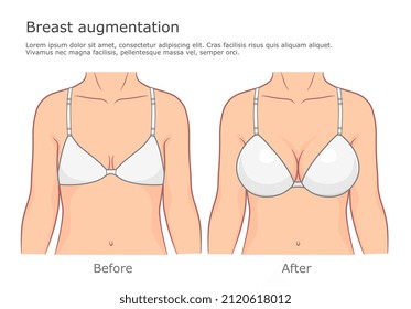 Breast augmentation vector illustration. Before and after front view.